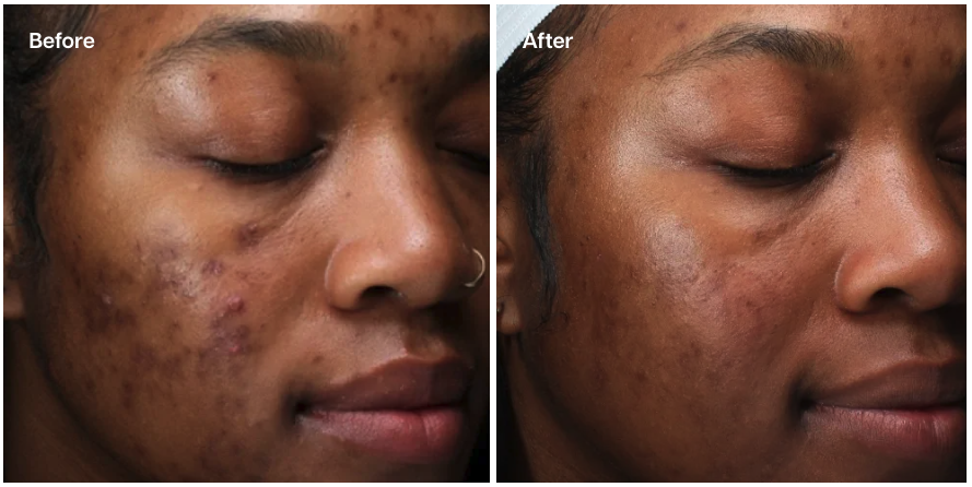 A side-by-side "Before and After" comparison showing a person's face. The "Before" image displays visible acne and hyperpigmentation, while the "After" image shows significantly clearer skin with reduced blemishes and a more even tone.