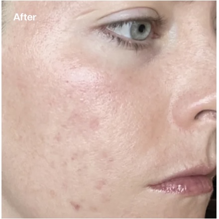 A close-up "After" image of a person's face, showing significantly smoother skin with reduced redness, fewer visible blemishes, and a more even texture around the cheek and jawline.