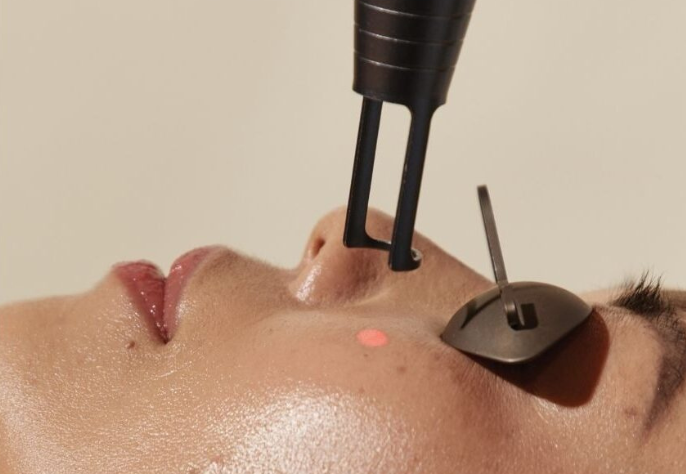 A close-up of a person lying down with protective eye shields, receiving a laser facial treatment on their nose from a professional device, with a visible red laser dot on their skin.
